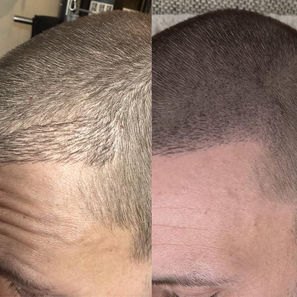 Hårfäste efter hårtransplantation, före och efter SMP