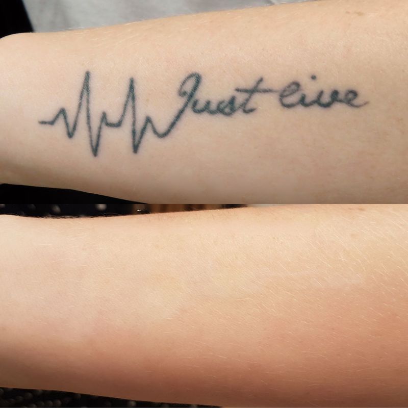 Tatueringsborttagning, före och efter laserbehandling av texttatuering på underarm