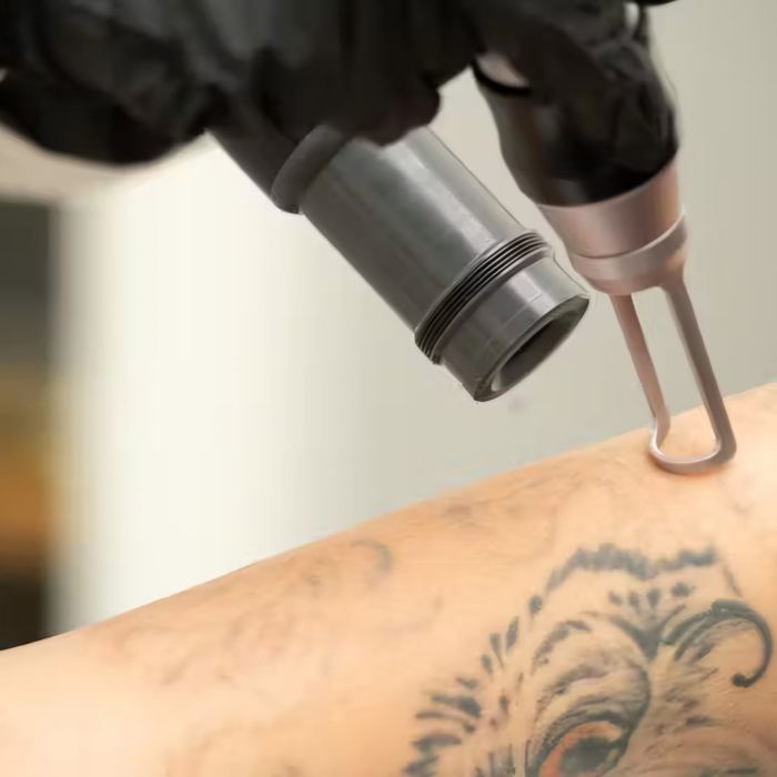Laserbehandling, Q-Terra Q10 i arbete med tatueringsborttagning